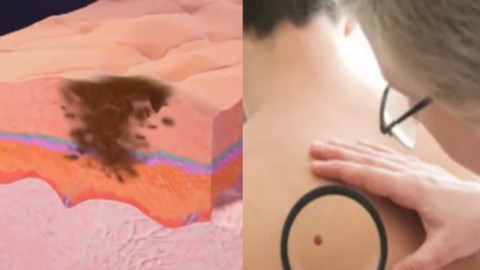 痣竟然也会诱发癌症,导致生命危险,我赶紧看了看身体上的痣
